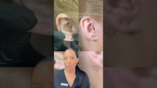 Earlobe repair before amp after at Dr Medispa [upl. by Terrell]