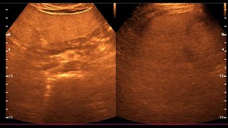 Fatty Liver  Diffuse hepatic steatosis  Liver Ultrasonogram [upl. by Legnaleugim]