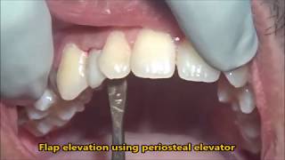 Extraction of retained milk tooth [upl. by Ainoval]