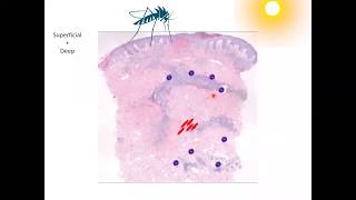 Perivascular Dermatitis Dr Hany Osman [upl. by Nor]