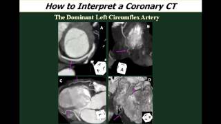 CCTA Lecture XI Practical and Efficient CCTA Analysis and Clinical Interpretation [upl. by Florella]