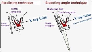 Dental Radiography Parallel angle vs Bisecting angle technique Basics  Part 1 [upl. by Nelram]