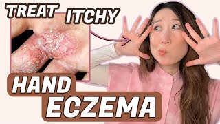 How to Treat Hand Eczema 🖐️ Dr Joyce Dermatologist [upl. by Ahseikal]