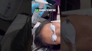 Effortlessly remove brown spots with Cryotherapy—quick minimal pain and effective results [upl. by Rudiger]