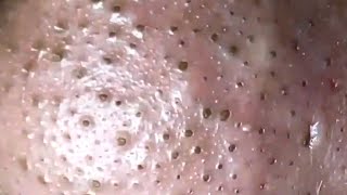 Blackheads amp Whiteheads Satisfying Removal 0004 [upl. by Anhcar521]