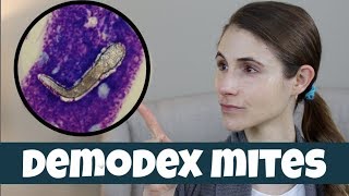 DEMODEX MITES ON YOUR SKIN DR DRAY [upl. by Bonnes]