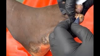 Limpeza de bicho de pé em africano african foot cleaning with jiggers [upl. by Isnan57]