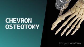 Chevron Osteotomy [upl. by Arrahs]