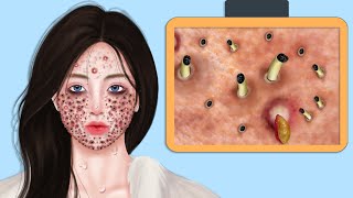 ASMR Giant Acne amp Black Head Pimple Removal  Acne Deep Cleaning Animation [upl. by Runkle]