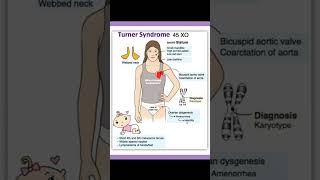 Turners syndrome [upl. by Franni]