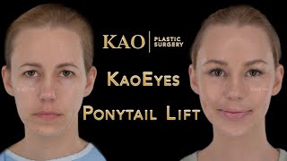 Picture Perfect Plastic Surgery  Scarless Facelift Before amp After Video  Ponytail Lift  Dr Kao [upl. by Amilb]