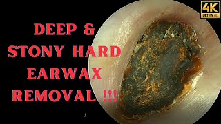 DEEP amp Stony HARD Earwax Removal Very Satisfying Video [upl. by Kepner]