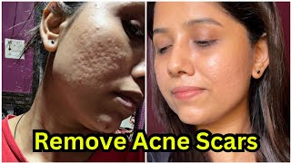 How to remove acne scars 😍  Acne scars remove treatment  My skin transformation journey [upl. by Ahsilam426]