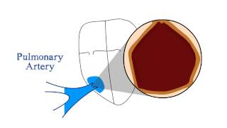 Pulmonary Stenosis [upl. by Adikam]