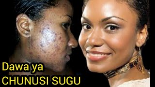 DAWA YA CHUNUSI SUGU  Sababu za chunusi  Acne causes and treatment [upl. by Nitsuga741]