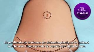 Abdominoplastia  Clínica Thüel [upl. by Nosirrag]