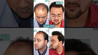 From Grade 6 Baldness to a Full Head of Hair DHI Hair Transplant [upl. by Haynor]