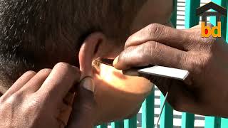 ►Painful Fungal Infected Earwax Removal in Very Anxious Client II Got Relief after Procedure [upl. by Sachsse325]