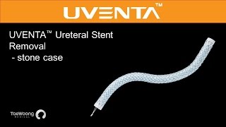 UVENTA™ Ureteral Stent  Removal stone case  UVENTA 요관 스텐트  輸尿管支架  尿管ステント [upl. by Fesuy]