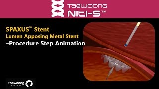 Niti S™ SPAXUS™ Stent Procedure Step Animation [upl. by Enitnatsnoc]