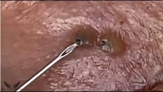 Severe Eye Blackhead Removal  Acne Cystic Treatment Spa  Pimple Popping Elderly Acne Remove  056 [upl. by Eened]