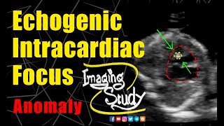 Fetal Echogenic Intracardiac Focus  Ultrasound  Anomaly  Case 261 [upl. by Cindelyn]