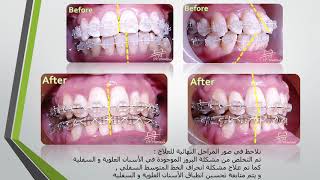 علاج بروز الأسنان العلوية و السفلية من خلال تقويم الأسنان Orthodontic treatment of teeth protrusion [upl. by Haeel872]