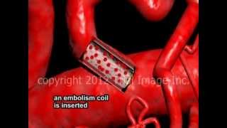 Embolization of arteries video  Animation by Cal Shipley MD [upl. by Sadonia359]