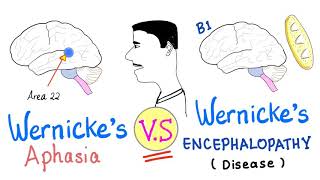 Wernicke’s Aphasia vs Wernickes Encephalopathy  Neurology [upl. by Nyraf676]