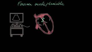 Foramen ovale perméable  CIA  Docteur Synapse [upl. by Yug]