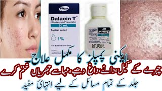 Best Acne Lotion  Dalacin T Lotion  Calindamycin 1 Acne Lotion Review In Urdu Hindi [upl. by Nica773]