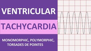 Ventricular Tachycardia Vtach ECG Interpretation Treatment Nursing NCLEX Review [upl. by Arok]