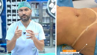 Laser Liposuction Procedure [upl. by Adrell]