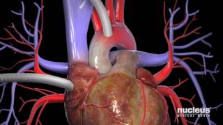 Coronary Artery Bypass Graft  Understanding Cardiovascular Disease [upl. by Renato737]