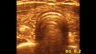 Understanding Ultrasonographical Features of Chronic Thyroiditis  Chronic Thyroiditis [upl. by Releehw]