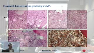 Seminar om MPN Myelofibrose MF ved Hoa Tran 221122 [upl. by Ennaylloh407]