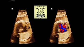 d TGA amp VSD  DORV FETAL ECHO [upl. by Eizzo636]