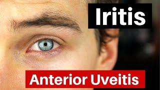 Iritis  What is Anterior Uveitis Doctor Explains [upl. by Bradleigh264]