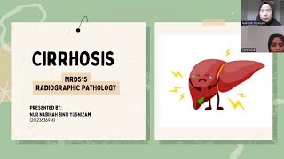 MRD515 VIDEO PRESENTATION CIRRHOSIS DISEASE [upl. by Furnary]