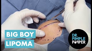 The Big Boy Lipoma [upl. by Esaertal355]