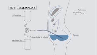 Understanding peritoneal dialysis [upl. by Daigle248]