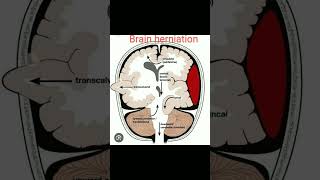 Types of brain herniation [upl. by Alvin]