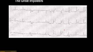 1215 Lead ECG MI Imposter 1 [upl. by Nnitsuj833]