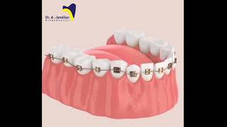 How Orthodontics Straightens Teeth dentist orthodontics bonding Bracewirebracket Fixed [upl. by Dosh]