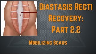 Diastasis Recti Recovery Part 22  Mobilizing Scars [upl. by Thapa885]