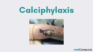 Calciphylaxis CUA [upl. by Aroved23]