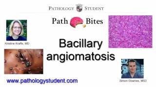 Path Bites  Bacillary angiomatosis [upl. by Fredela109]