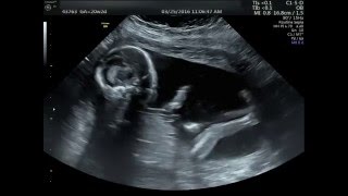 20 week Ultrasound Its a boy [upl. by Alicsirp737]