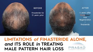 Why Finasteride is Limited in Thickening Thinning Hair and Getting Thicker Hair Beyond Finasteride [upl. by Phillie]