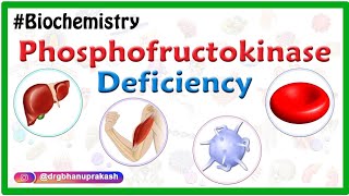 Phosphofructokinase deficiency Animation Tarui disease  GlycogenStorage Disease Type VII  USMLE [upl. by Aleras]